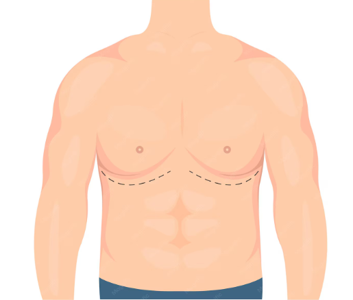 Gynecomastia