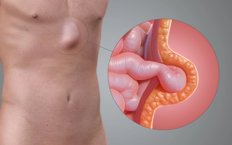 Hernia