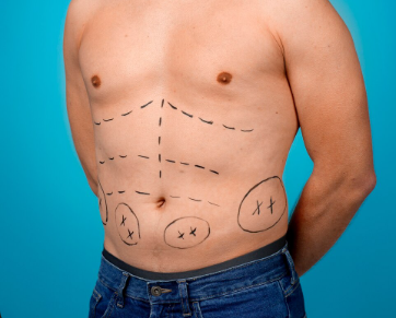 Liposuction