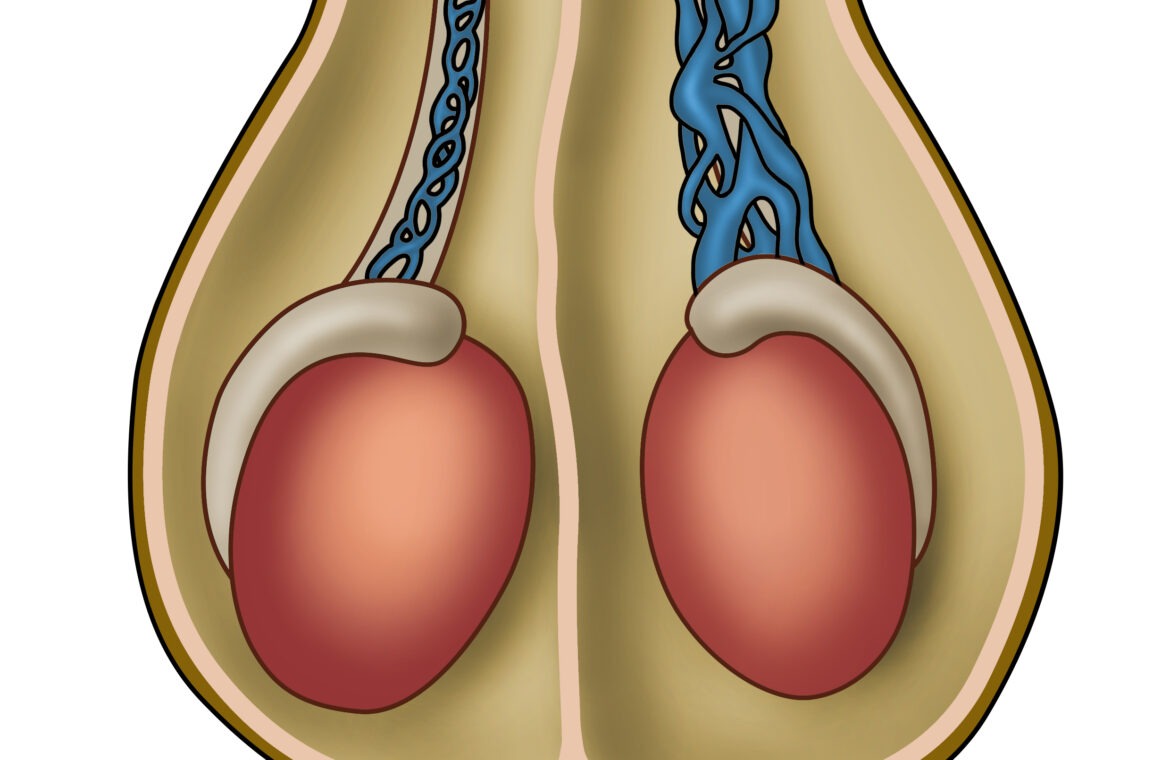 Varicocele